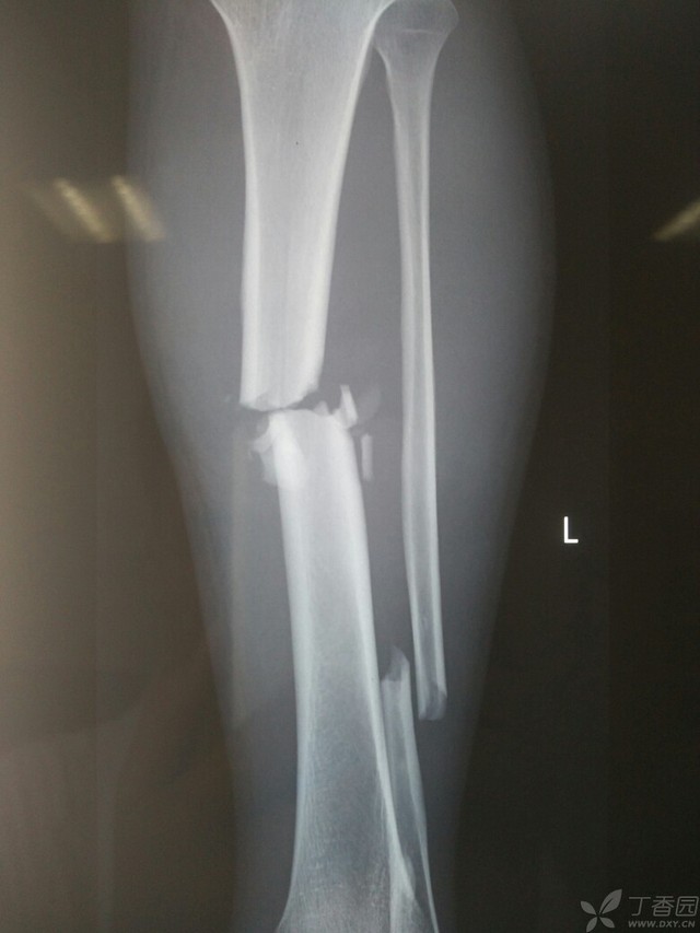 科技重塑脛腓骨骨折康復(fù)之旅，引領(lǐng)未來體驗新篇章