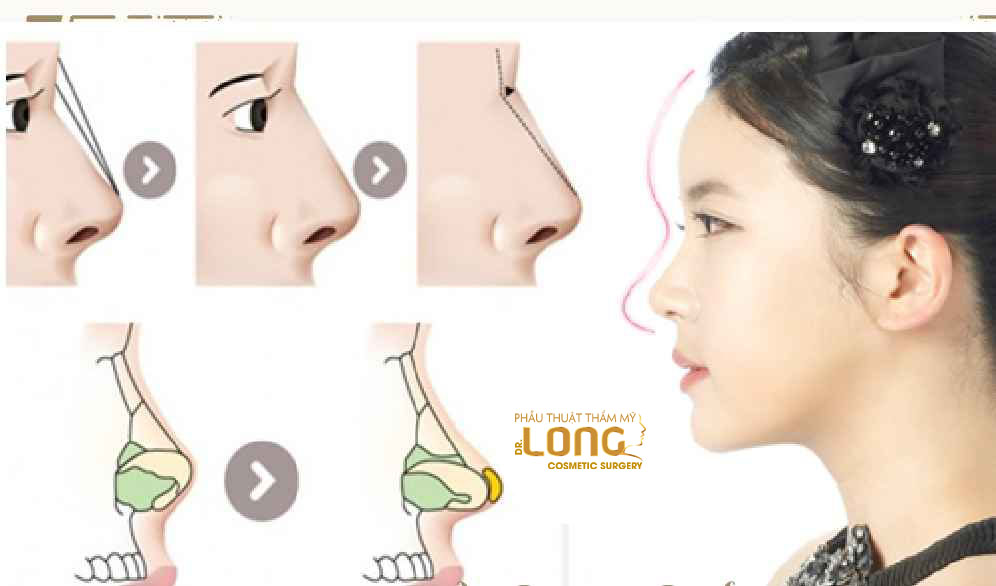 最新鼻整形技術(shù)重塑自信，煥發(fā)新生之美