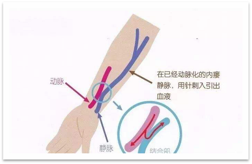 靜脈瘺最新資訊，掌握最前沿的健康信息
